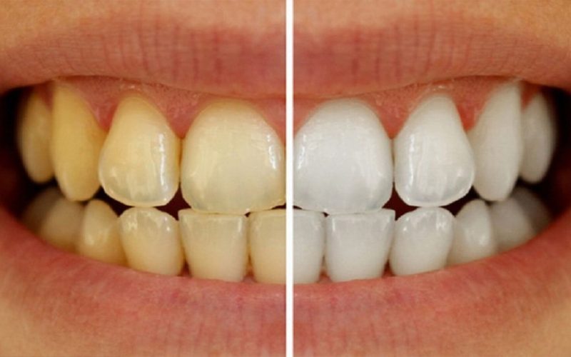“في دقيقتين بس” تبييض الأسنان والتخلص من الاصفرار بوصفات جبارة